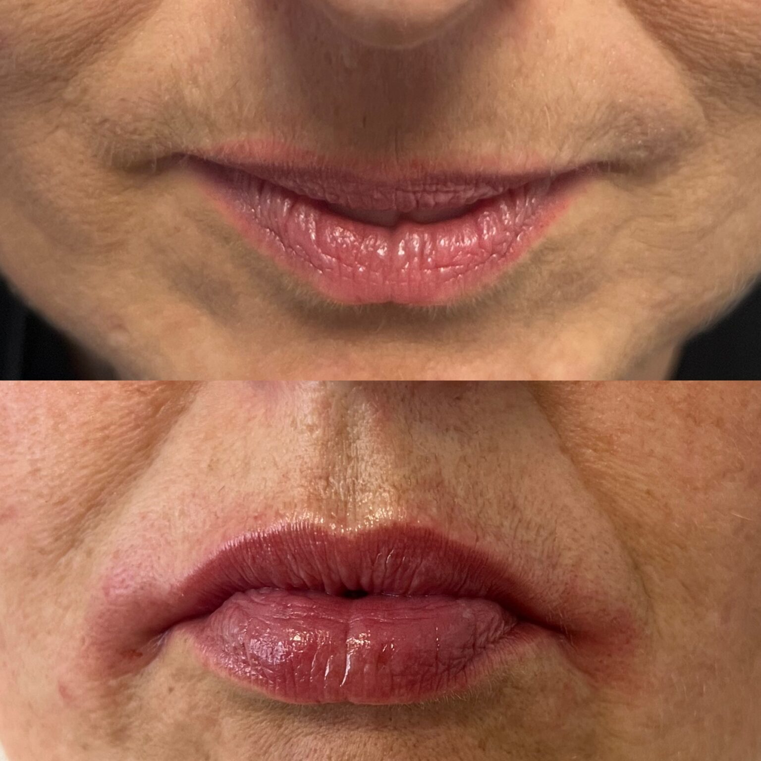 Medicina estética corporal en A Coruña eliminación de grasa localizada y celulitis.