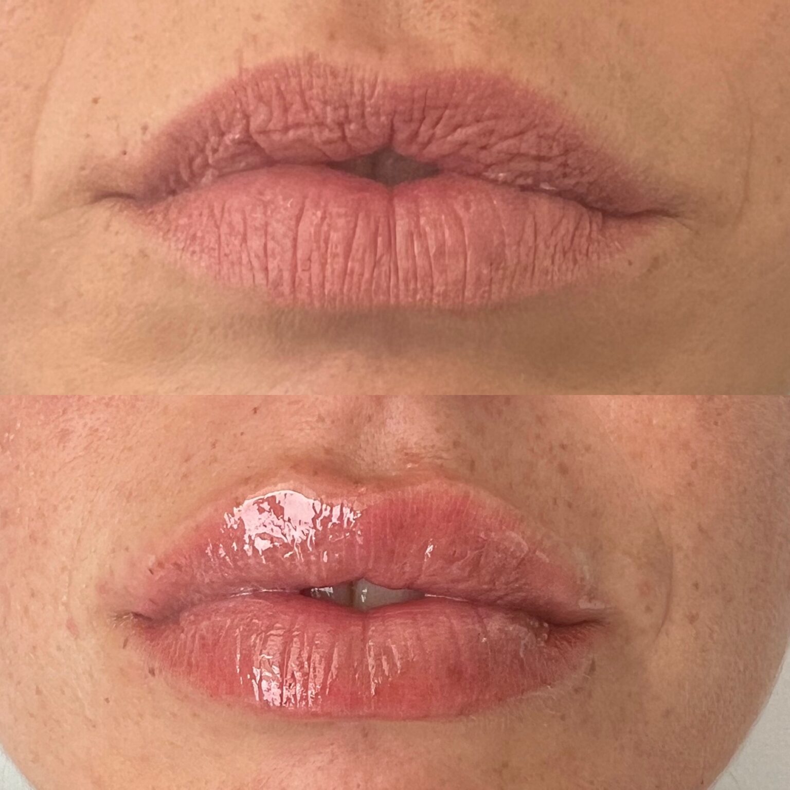 Tratamiento de remodelación corporal y reafirmación de piel en Clínica Dr Luna A Coruña.