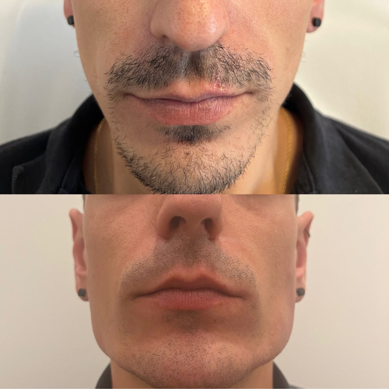 Uso de aparatología médica para manchas faciales y flacidez en Clínica Dr Luna Fene.